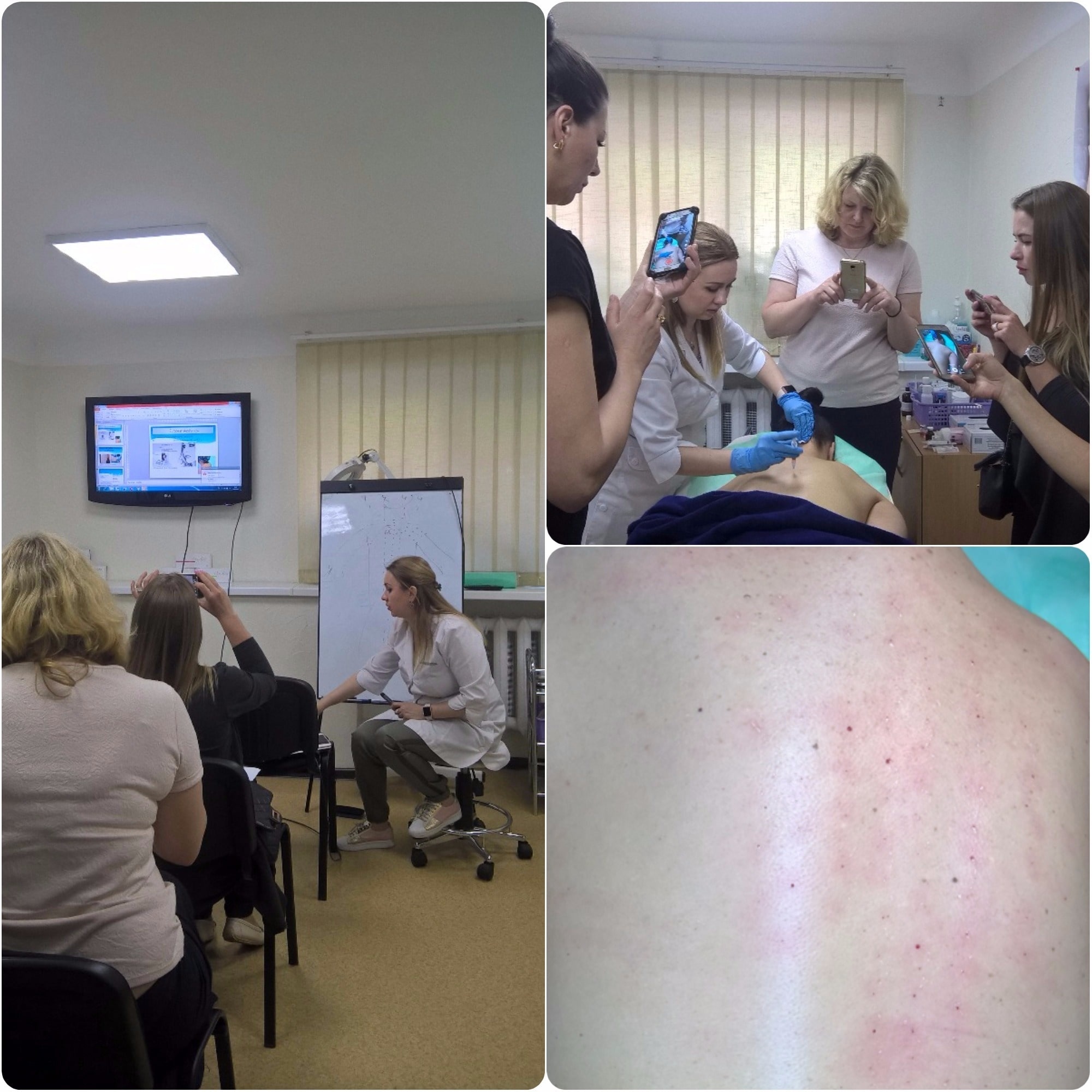 Липолитические мезококтейли #MesoExpert уменьшают локальные жировые отложения, сложно поддающиеся коррекции в области живота, бедер, ягодиц, коленей, двойного подбородка, грыж нижнего века, также способствуют устранению целлюлита.